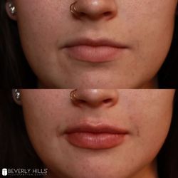 Get your perfect pout on with Beverly Hills Rejuvenation! Our treatments are tailored for you so you can achieve the lips of your dreams.