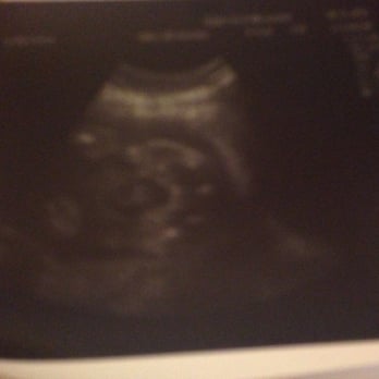 Baby's First Ultrasound - Extremely blurry & poor quality - Diagnostic Imaging Near Me - Phoenix, Arizona
