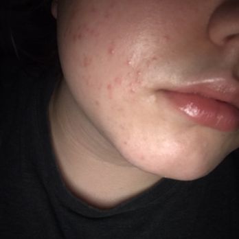 Beauty & Style Salon - Badly burned and with a rash from getting my face waxed. - Hair Salons Near Me - Palmdale, California Beauty & Style Salon - Badly burned and with a rash from getting my face waxed. - Hair Salons Near Me - Palmdale, California