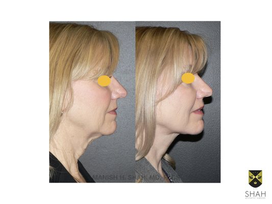 Shah Aesthetic Surgery - Rhinoplasty and Facelift Specialist by null