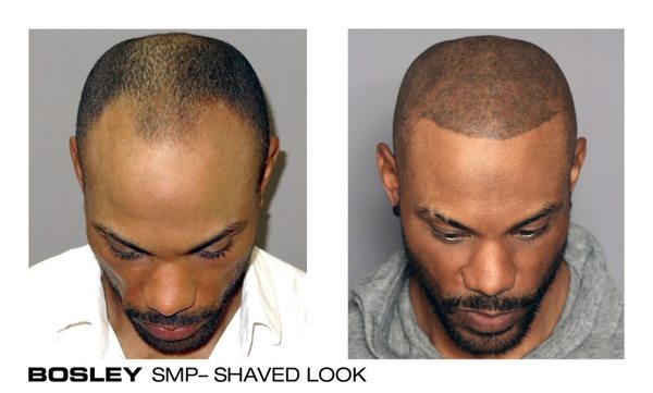 Bosley Hair Transplant Restoration 4001 S 700 E Salt Lake City Ut Hair Replacement Mapquest