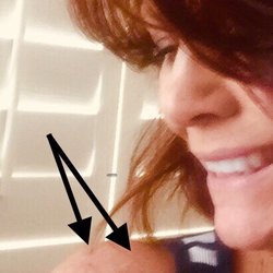 Canyon Vista Bone & Joint Surgery - Surgery incisions barely visible after two months!
