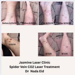 Jasmine Laser Hair Removal - Spider Vein CO2 Laser Treatment