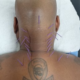 Just a few needles!