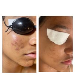 Refresh Day Spa - Acne Clearing Facial With Red Light