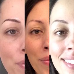 Live Skin - 1. right after first session 2. healed after first session 3. healed after second session