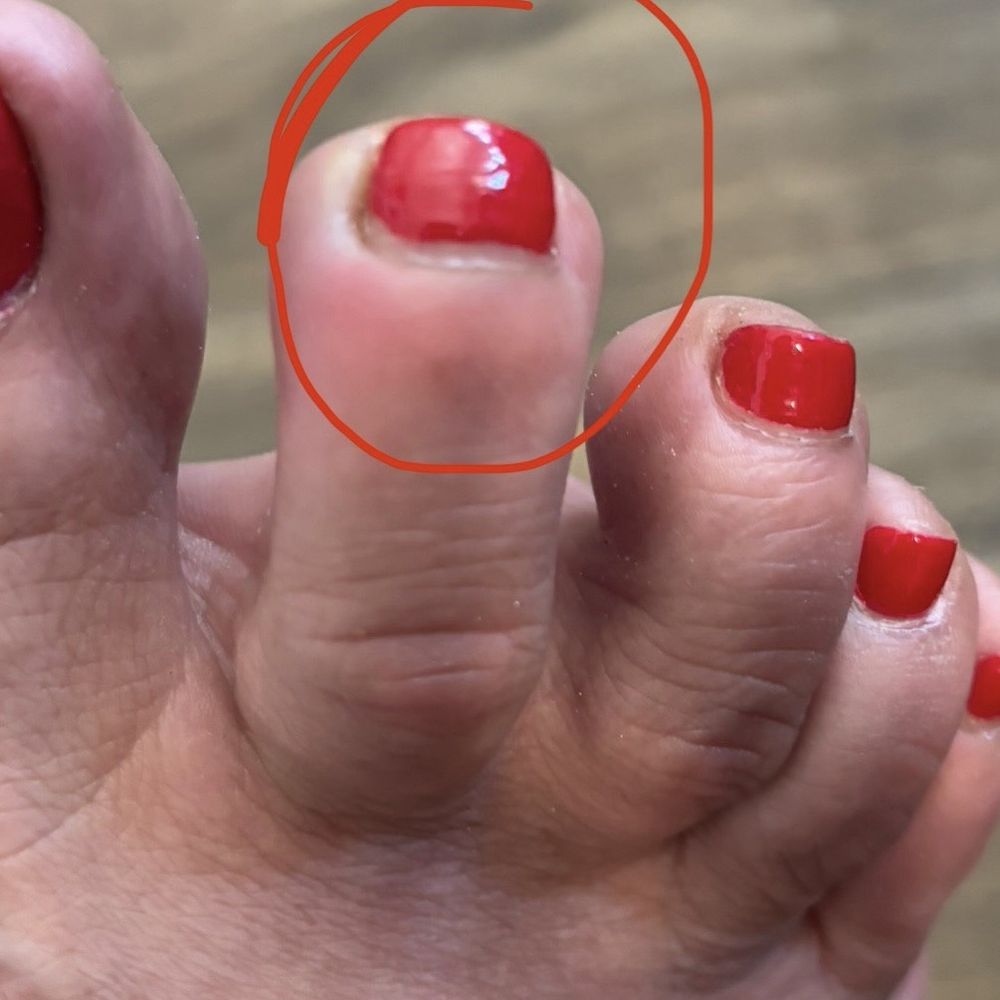Patsy Nails Spa - My infected toe. - Nail Salons Near Me - Inglewood, California Patsy Nails Spa - My infected toe. - Nail Salons Near Me - Inglewood, California