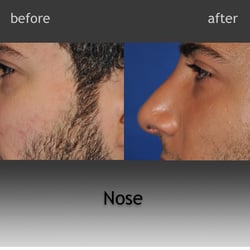 Aesthetic Surgery Center:  Michael R. Macdonald, MD - Rhinoplasty removes large dorsal hump and makes other more subtle improvements - correcting angle between his nose & upper lip.