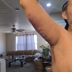 Reynolds Plastic Surgery - Day 2 post op arm lift scar
