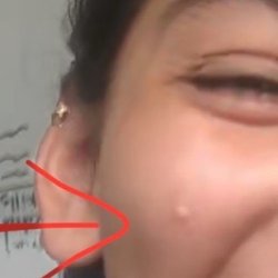 Pedro Steven D MD - Barely noticeable Small cyst week of surgery