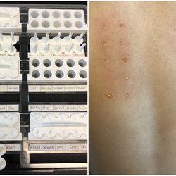 Food Allergy Institute - The skin test is the first test they do. they press the allergens (left) onto the child's back (right) to see how they react