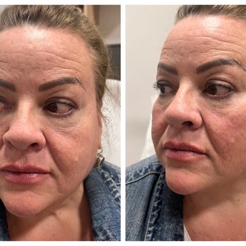 RegenerateMe - Before and after. I'm 57. Look at this under eyes. Amazing! I don't do anything else but that. I look awake. - Medical Spas Near Me - Las Vegas, Nevada
