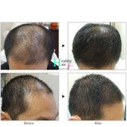 Healthy Hair Clinic - Hair Loss Treatment that grows hair back