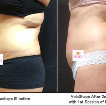 Miami Body Aesthetics - VelaShape + UltraShape body contouring-FDA approved, in 3 pain-free sessions! These results - after only 2 sessions two weeks apart. - Laser Hair Removal Near Me - Miami, Florida