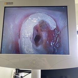 West Nyack Dental - Sorry for this ... the small little dot is the nerve that is still alive the big hole is where the screw was placed