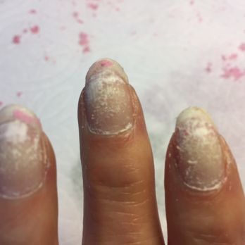 Fuchsia Spa - This is how badly my own natural nails were ruined by nail tech at Fushia Spa in Mesa. - Day Spas Near Me - Mesa, Arizona Fuchsia Spa - This is how badly my own natural nails were ruined by nail tech at Fushia Spa in Mesa. - Day Spas Near Me - Mesa, Arizona