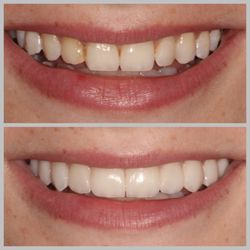 Bright Smile Dental - 10 Porcelain No-Prep Veneers Before & After.
No Alterations or drilling to natural teeth