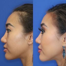 Left: before permanent filler rhinoplasty After: permanent filler rhinoplasty Left: before permanent filler rhinoplasty After: permanent filler rhinoplasty