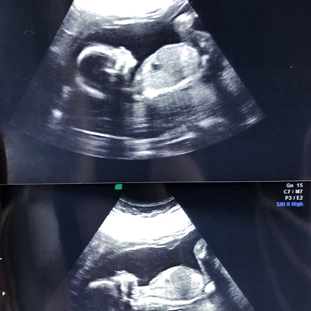 Sweet Miracles 3D & 4D Ultrasound - Diagnostic Imaging Near Me - Buford, Georgia Sweet Miracles 3D & 4D Ultrasound - Diagnostic Imaging Near Me - Buford, Georgia