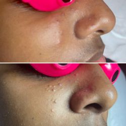 Grace Threading - You deserve clear skin we take all black and white head out . Book clarity facial @affordable price