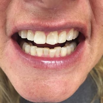 Maui Whitening - Glendale - AFTER - Teeth Whitening Near Me - Glendale, Arizona Maui Whitening - Glendale - AFTER - Teeth Whitening Near Me - Glendale, Arizona