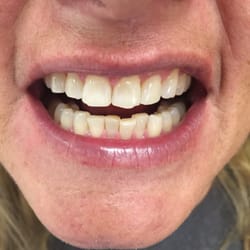 Maui Whitening - Glendale - AFTER