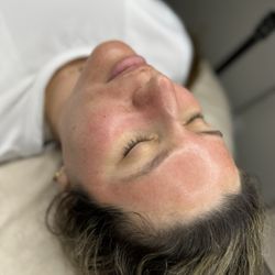 Harmony Studio Brows & Skincare - Microneedling treatment