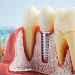 Dental Implants are natural-looking and help preserve your mouth's functions.