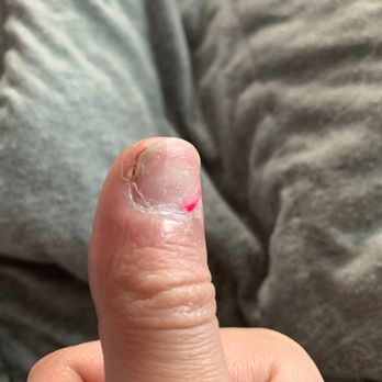Canyon Nails - After a few days of healing and antibiotics - Nail Salons Near Me - Puyallup, Washington Canyon Nails - After a few days of healing and antibiotics - Nail Salons Near Me - Puyallup, Washington