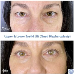 The Garden Medical Spa - Upper and lower eyelid lift