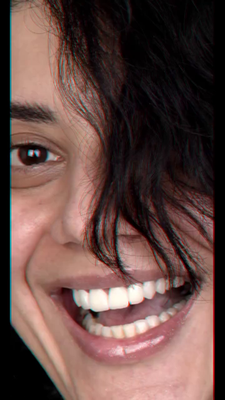 Gum Surgery + Crown - A perfect smile in six weeks.A patient came to Epic Smile Dental Clinic with an urgent request—she needed a complete smile makeover in just six weeks before embarking on a long journey. After detailed photography, 2D and 3D smile design, we discovered her gum line and teeth levels were uneven, with her left side higher than the right. We began with gum surgery to achieve balanced, proportional teeth. Then, we corrected her midline, symmetry, and replaced old crowns with natural zirconia crowns and veneers. The result? A flawless, natural smile transformation—just in time for her trip