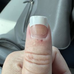Bumpy nail and burn from sharp buffer Bumpy nail and burn from sharp buffer