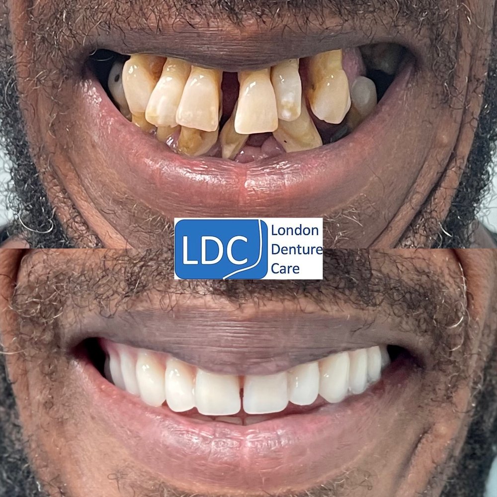 LONDON DENTURE CARE NEW DENTURE AND DENTURE REPAIR 121 Earls court