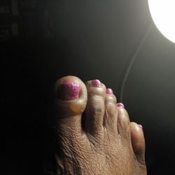 Affordable Podiatry - The allergic reaction from having a fake nail put on my toe then I had the fake nails removed.