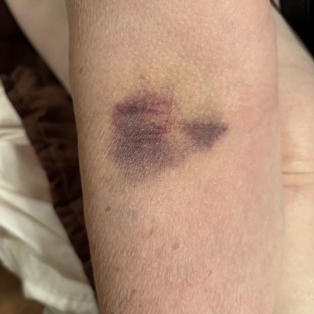 Bruised arm