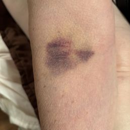Bruised arm