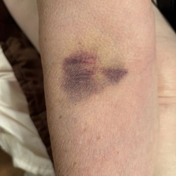 Quest Diagnostics - Bruised arm - Laboratory Testing Near Me - Tustin, California
