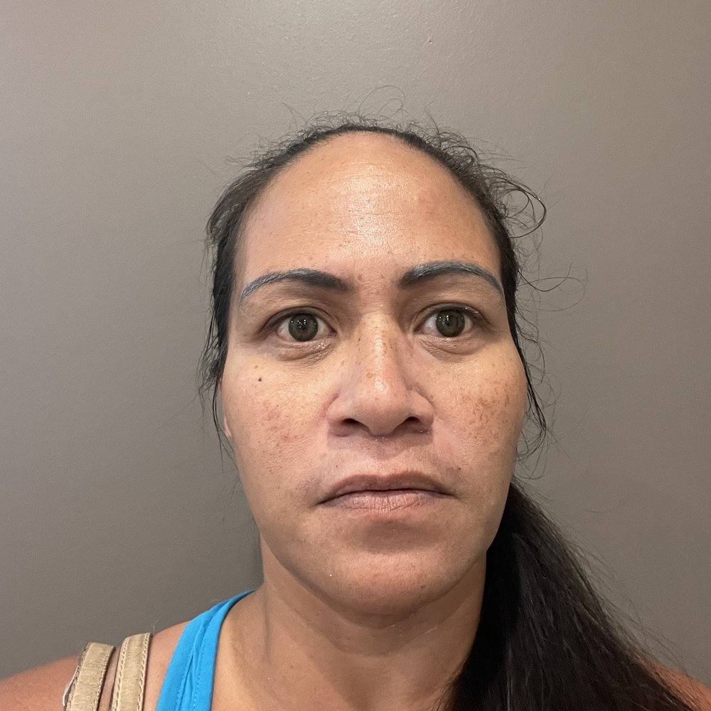 Resveralife - My AFYER. K, so look at my forehead. NO WRINKLES! Hehehe... - Acne Treatment Near Me - Aiea, Hawaii