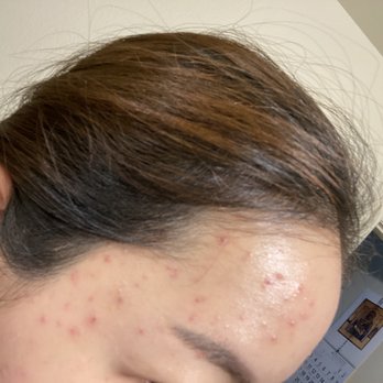 ES Skin Care - Before the skincare - Skin Care Near Me - Buena Park, California