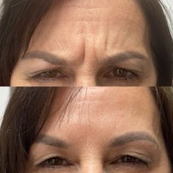 Beyond Beauty Med Spa - Dysport between the eyes brightens your whole face!