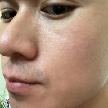 Balfour Dermatology - No more mole right on the bottom corner of my nose. Gross. - Dermatologists Near Me - Brentwood, California