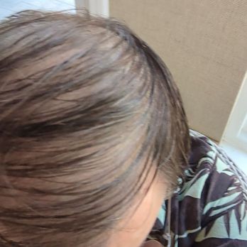 Be Clinical - 6 mo. post treatment PRP (Aug 22, 2023) Begin Finasteride July 23' . minoxidil. Continue biotene 10,000mcg . vitamin E w cond - Skin Care Near Me - San Ramon, California Be Clinical - 6 mo. post treatment PRP (Aug 22, 2023) Begin Finasteride July 23' . minoxidil. Continue biotene 10,000mcg . vitamin E w cond - Skin Care Near Me - San Ramon, California