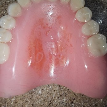 Fioritto Family Dental - Stained upper. Not sealed properly. - Cosmetic Dentists Near Me - Mentor, Ohio