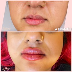 Beauty Me By D - Lip fillers before and after