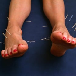 Abba Anderson Acupuncture - Acupuncture is highly effective in treating foot pain and plantar fascitiis!
