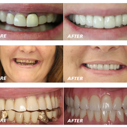 Carrollton Advanced Family Dentistry - Treatemnt photos done by Dr. Markose, DDS, MSD Prosthodontist