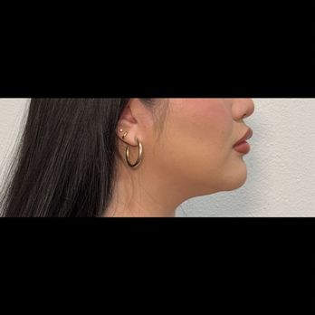 PlasticsMD - Before surgery - Plastic Surgeons Near Me - Huntington Beach, California