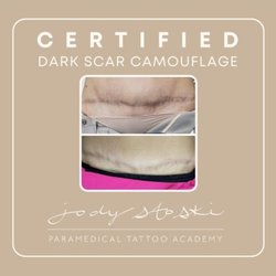 Vancouver Cosmetic Tattoo - Deark Scar Camouflage