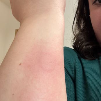 Spa Cerro - Immediate aftermath of burn received at Spa Cerro. - Massage Therapy Near Me - San Luis Obispo, California