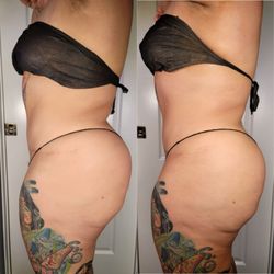 Your Besties Esti - Before and after ice sculpting session. (Only 1 session)
